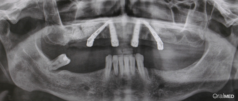 implantes dentarios 19mm