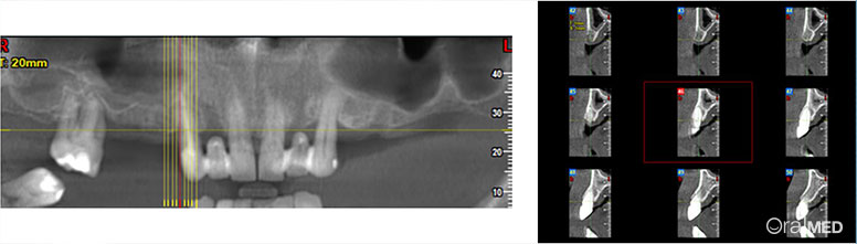 Implantes 19mm - corte parede lateral da fossa nasal direita